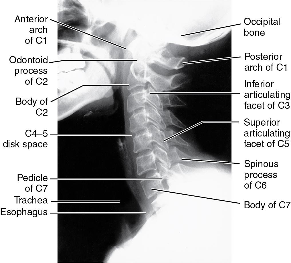 Fig. 9.1, Normal lateral cervical radiograph.