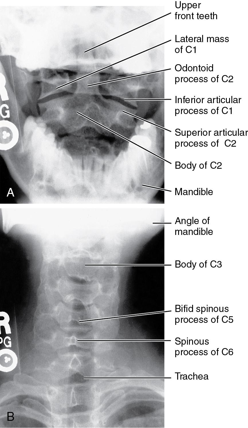 Fig. 9.2, (A) Normal anteroposterior (AP) odontoid view and (B) standard AP cervical view.