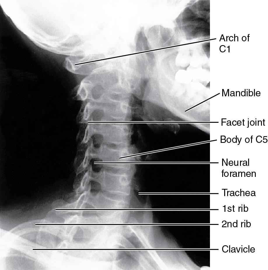 Fig. 9.3, Normal anatomy of the cervical spine on the oblique view.