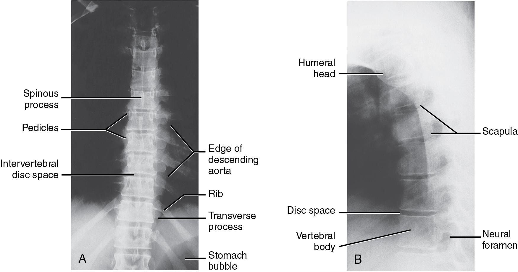 Fig. 9.4, Normal anatomy of the thoracic spine. (A) Anteroposterior, and (B) lateral views.