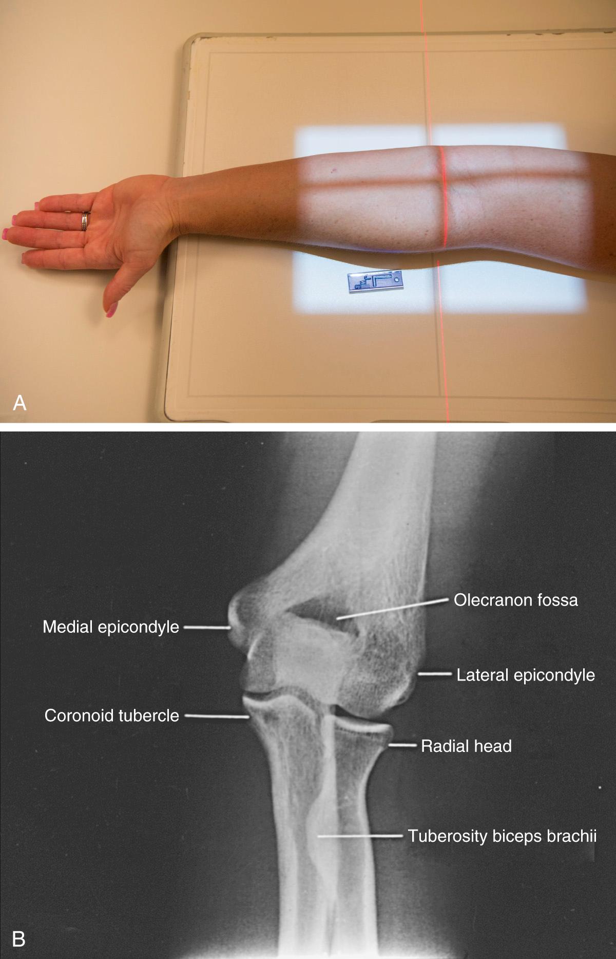 FIG 6.1, Anteroposterior (AP) view. (A) Elbow in position for the AP view. The arm is level with the cassette, with the hand positioned palm up. The x-ray beam is perpendicular to the elbow. (B) AP radiograph with anatomic labels.