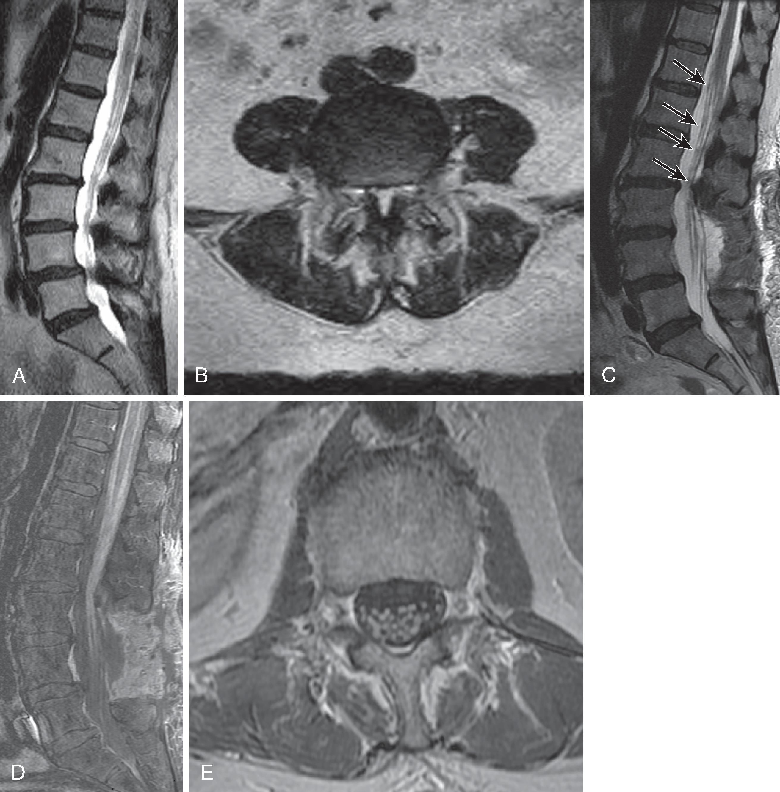 Figure 20.1, Diminished sensitivity of low field strength upright MRI to sinister lesions. A 74-year-old female presented with bilateral lower extremity weakness and pain with a low field strength upright MRI from another institution. Sagittal T2 image (A) and axial T2 image (B) at the L4 level show degenerative spondylolisthesis at L4 with central spinal canal compromise. She underwent an L3–L5 decompression without change in symptoms. A 1.5 Tesla MRI performed three weeks postoperatively demonstrated nodularity (arrows) in the cauda equina on a T2 sagittal image (C) . Gadolinium-enhanced fat-saturated T1 sagittal (D) and axial (E) images demonstrate diffuse leptomeningeal metastases from breast cancer. She died in two months. A high quality preoperative MRI would have likely led to the diagnosis and avoided an unnecessary operation. MRI, Magnetic resonance imaging. (From Khalil JG, Nassr A, Maus TP. Physiologic imaging of the spine. Radiol Clin North Am. 2012;50:599–611.)