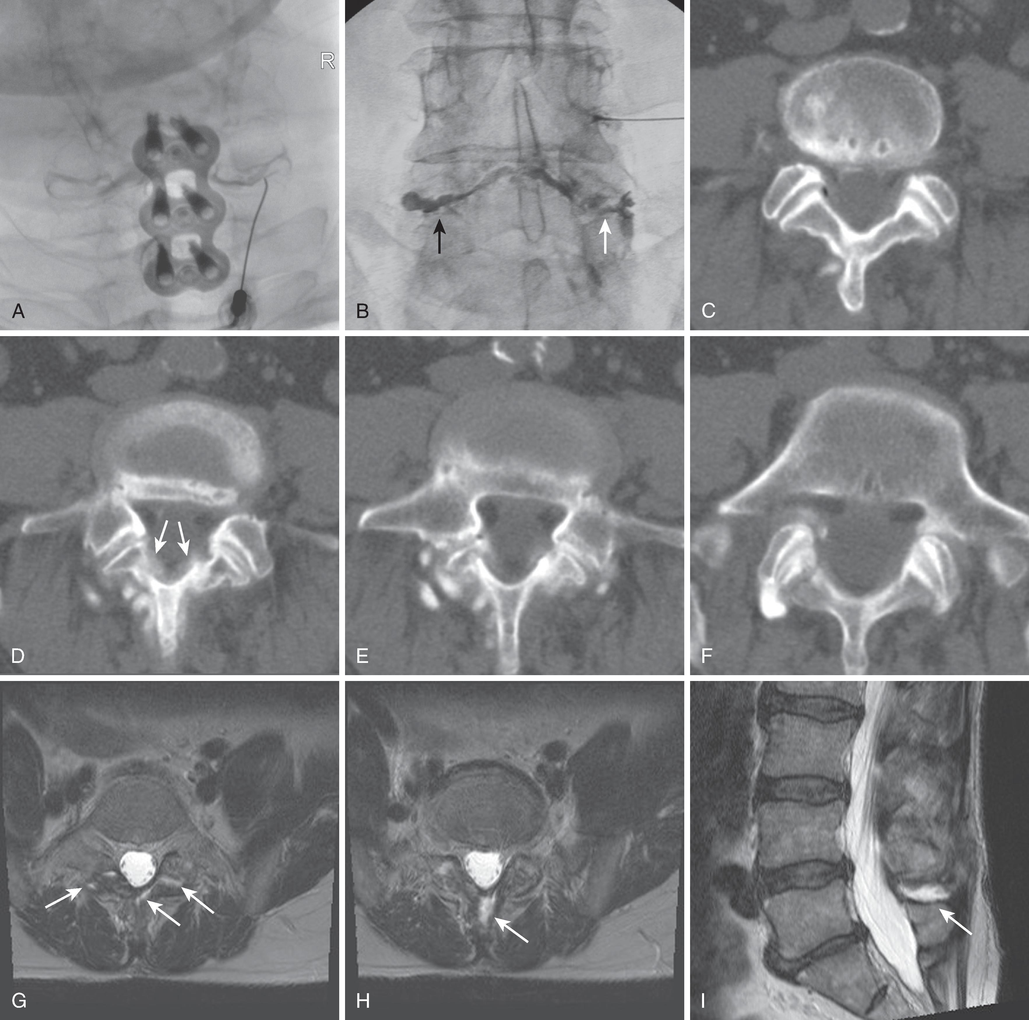 Figure 20.11, The space of Okada. Frontal fluoroscopic image (A) demonstrates the space of Okada providing communication between the bilateral C6–7 facets via the right-sided injection. In another patient (B), an attempted right L4 transforaminal injection opacified the superior recess of the L4–5 facet, traversed an L5 pars defect (white arrow) to the right L5–S1 facet, and opacified the space of Okada to a left L5 pars defect (black arrow) and the left L4 and L5 facets. Subsequent computed tomography (C, D, E, F) confirms the opacification of all these structures. The space of Okada is marked by the white arrows in (D) . The space of Okada may contain a small amount of fluid, which appears as T2 hyperintensity ( white arrows, G, H, I ). Note continuity with interspinous ligament ( arrow in [H] and [I] ). Figure 20.11,cont’d. In a final patient, an attempted interlaminar injection (needle placement images J, K ) opacified the interspinous ligament ( white arrow in [L] ) and the left L4–5 facet ( black arrows in [L] ) via the space of Okada. This space ( black arrows in [M] ) is posterior to the ligamentum flavum; the needle was advanced ventrally into the epidural space without incident. (From Murthy NS, Maus TP, Aprill C. The retrodural space of Okada. AJR Am J Roentgenol . 2011;196:W784-W789.)