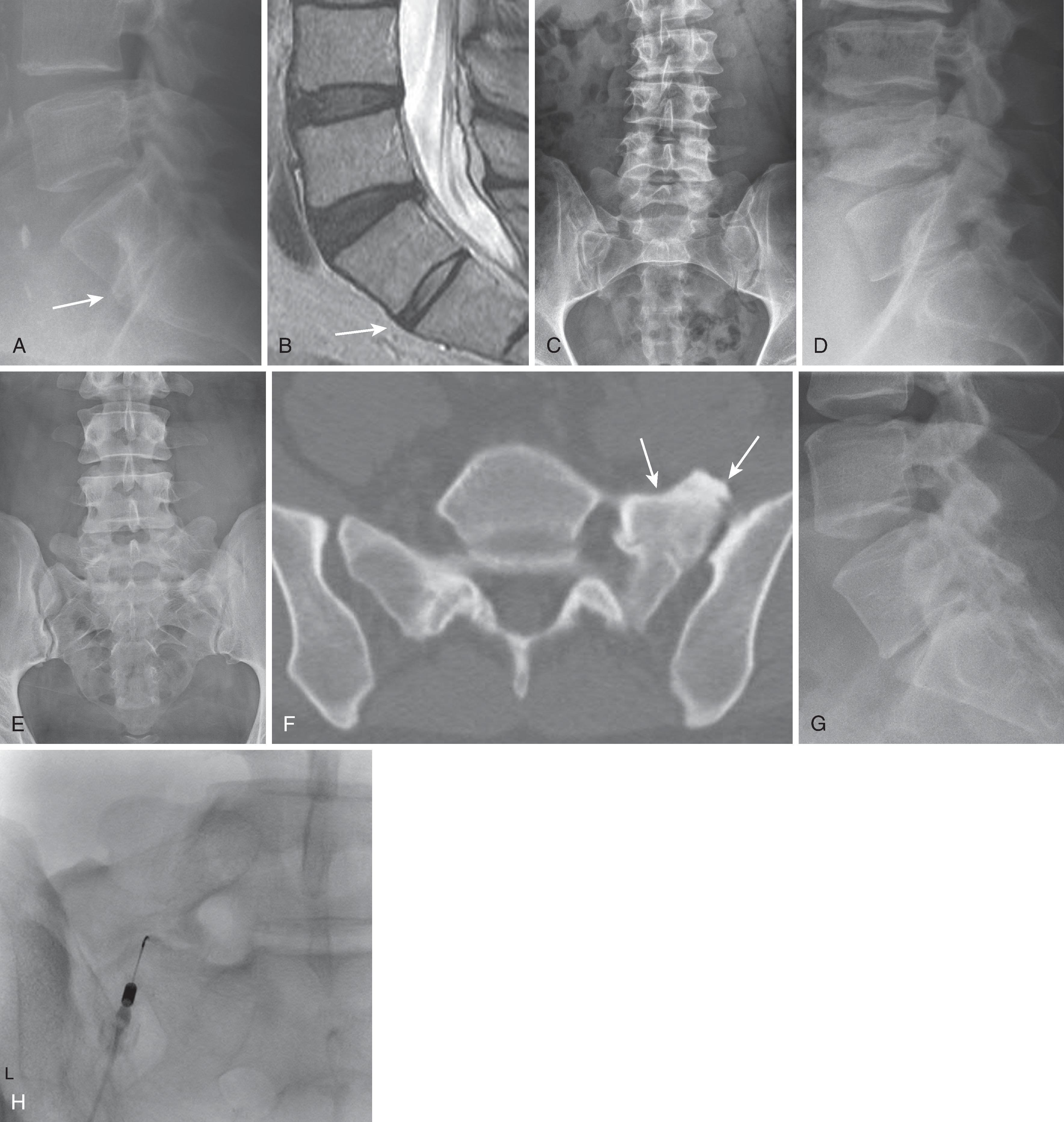 Figure 20.3, Transitional segments. Lateral radiograph (A) and sagittal T2 magnetic resonance image (B) demonstrate typical findings of a transitional segment interspace (arrows): a narrow disc space with parallel endplates and normal T2 signal intensity. Castellvi IIa transitional segment is demonstrated in frontal (C) and lateral (D) radiographs. Note right pseudoarticulation. In another patient, frontal radiograph (E) shows a left-sided pseudoarticulation, also seen on the axial computed tomography image ( arrows in [F] ). Narrow, parallel endplates are visible in the transitional interspace on the lateral radiograph (G) . This patient had axial pain attributed to the pseudoarticulation; this was injected (H) with relief of the index pain.