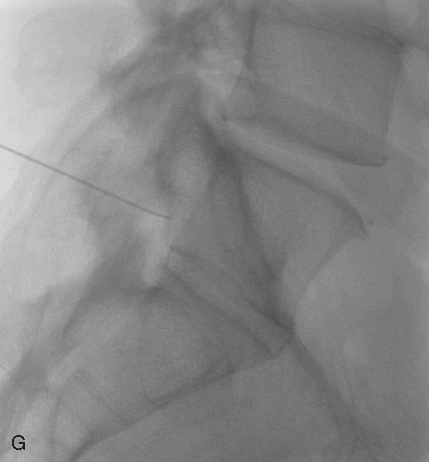 Figure 20.4, The importance of segmental enumeration. This 36-year-old male who has failed conservative care presents with a left-sided L5 radicular pain pattern involving the lateral thigh, lateral calf, and dorsum of the foot. His magnetic resonance image (MRI) (sagittal T2 [A] and axial T1 [B] at level of dotted line ) shows a subtle disc extrusion in the left lateral recess ( arrow in [B] ) at the second to last interspace. The lowest-most disc appears transitional. MRI scout (C) image demonstrates 24 presacral segments. Frontal and lateral radiographs (D and E) may suggest five lumbar vertebrae on cursory examination. Careful counting at fluoroscopy noted 11 rib-bearing vertebrae. T12 has no ribs, and L5 is transitional, Castellvi type 4. The transforaminal epidural steroid injection (F and G) was performed under the pedicle bearing the dysplastic left T5 transverse process and relieved the patient’s pain.Figure 20.4,cont’d Note (G) the typical appearance of transitional disc space. Careful enumeration of every case is the only way to avoid wrong segment interventions.