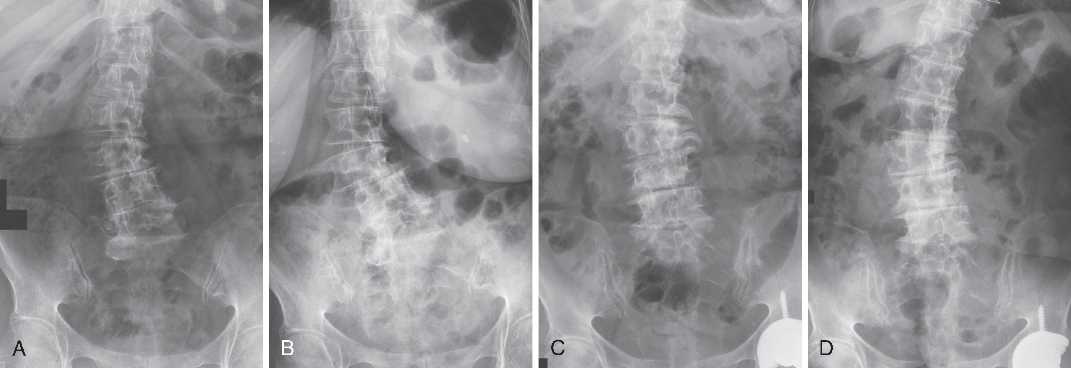 Figure 20.5, The effect of upright weight bearing radiographs on balance and deformity. Recumbent radiograph (A) shows lumbar scoliosis with a rotatory component, which is significantly exacerbated in a subsequent upright radiograph (B) . In another patient, the recumbent radiograph (C) underestimates the true scoliotic curve seen on an upright radiograph (D). Sagittal and coronal balance can only be assessed on upright, weight bearing imaging.