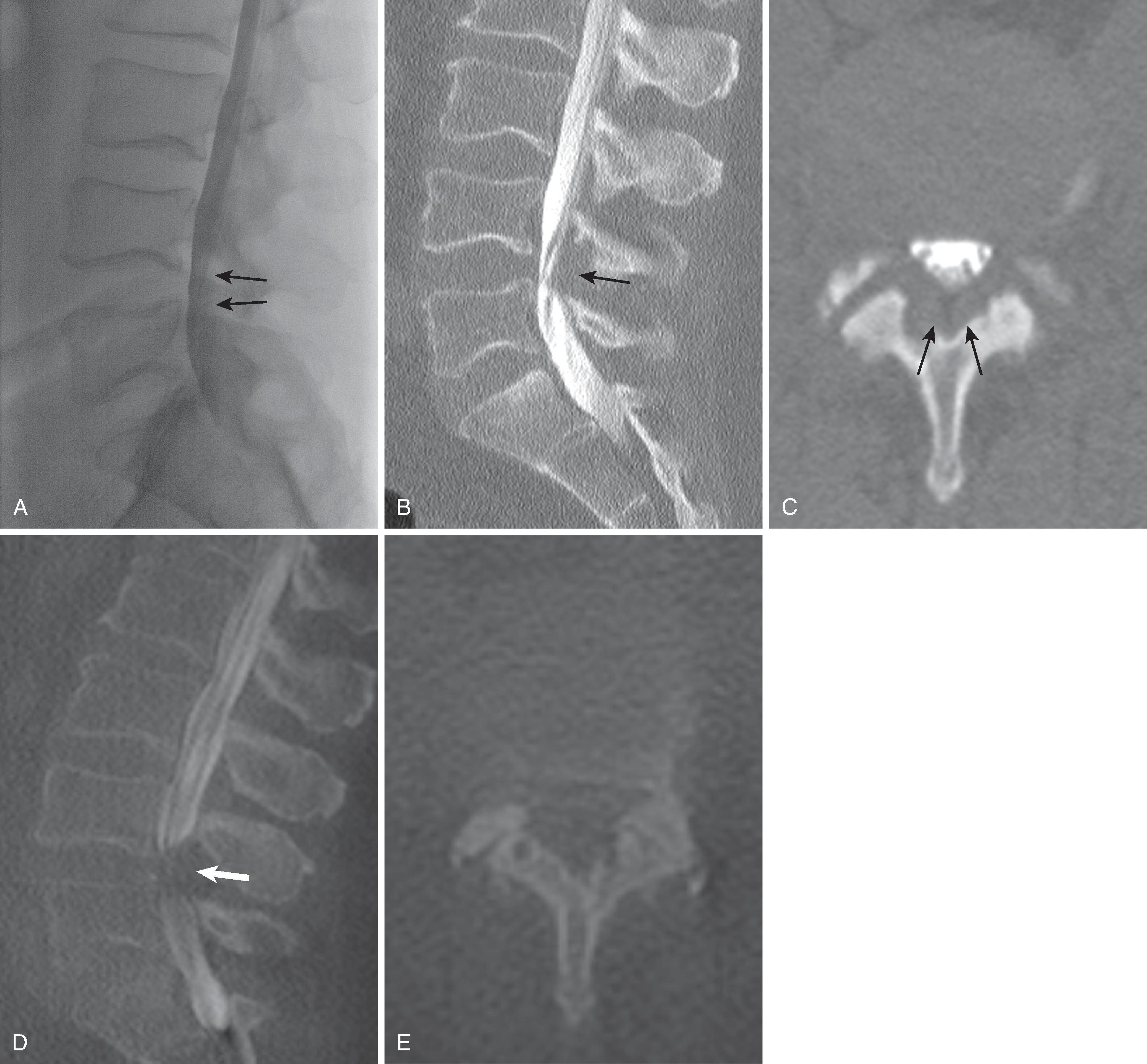 Figure 20.6, Ligamentum flavum redundancy (buckling) on upright myelography (cone-beam computed tomography [CT]). A 66-year-old man imaged for neurogenic intermittent claudication. Conventional myelogram in the lateral plane with the patient in the prone position (A) and postmyelogram sagittal (B) and axial CT at L4–5 interspace (C) with the patient in the prone position show minimal redundancy of the ligamentum flavum (black arrows) and mild central spinal canal compromise at the L4–5 level. Cone-beam CT myelography with the patient in an upright position demonstrates a marked increase in ligamentous buckling (white arrow) on the sagittal reconstruction (D) and complete effacement of the thecal sac on the axial reconstruction (E) . (Courtesy of Kent Thielen, MD, Mayo Clinic, Rochester, MN.)