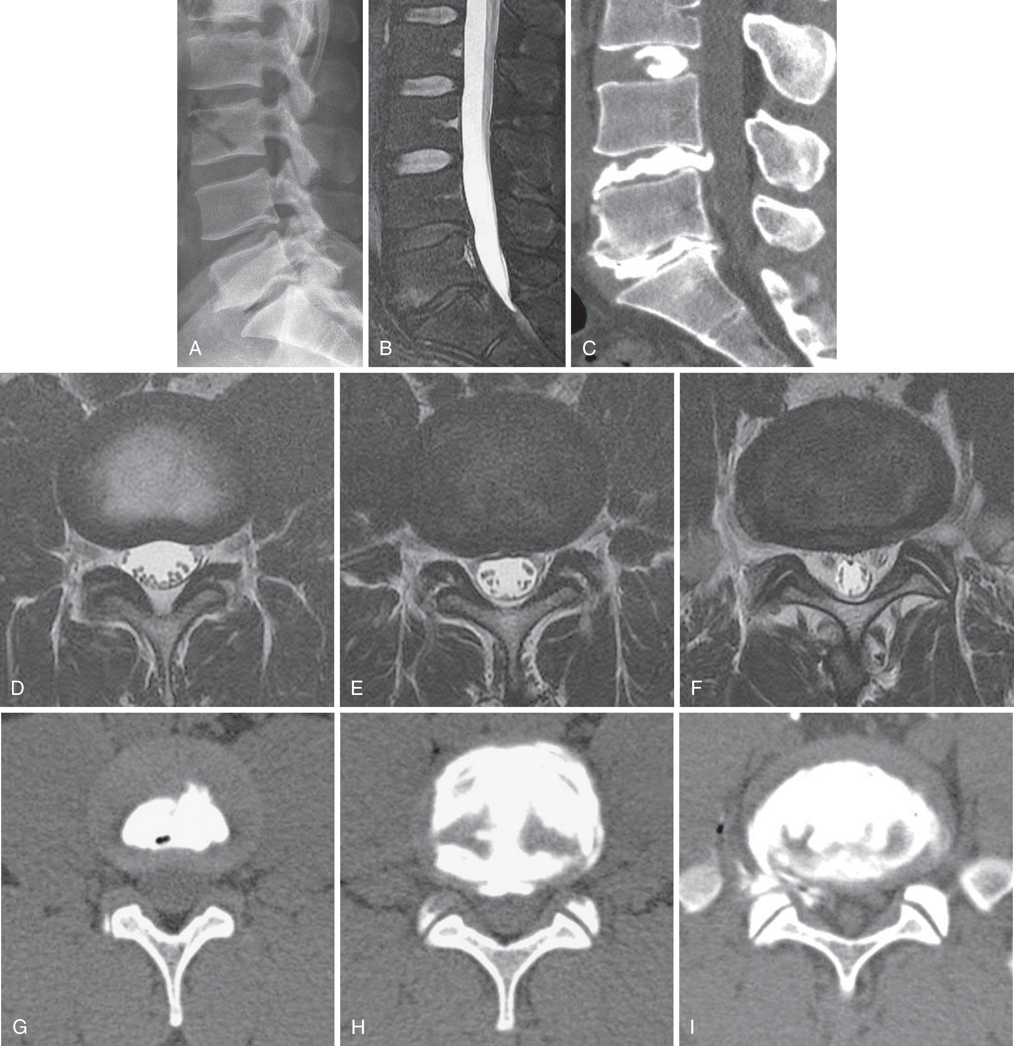 Figure 20.7, Disc Height and Nuclear T2 Signal Loss. Lateral radiograph (A) of a 50-year-old male with intractable axial pain. Note the loss of height of the lumbosacral disc, which contains gas. There is slight retrolisthesis of L4 on L5 and L5 on S1. Sagittal fat-saturated T2-weighted MRI (B) shows loss of T2 signal in the L4–5 and L5–S1 discs; normal upper lumbar discs. Axial T2-weighted images at L3–4 (C) , L4–5 (D) , and L5–S1 (E) demonstrate normal L3–4 disc, loss of T2 signal in L4–5 with a small central herniation, and a broad bulge at L5–S1. Sagittal CT discogram (F) and axial images at L3–4 (G) , L4–5 ( H), and L5–S1 (I) show normal L3–4 disc, Grade IV annular disruption at L4–5 and L5–S1 with a leak of contrast from the right posterolateral annulus at L5–S1. Patient had concordant axial pain at L4–5 and L5–S1 with a normal control disc at L3–4. (From Maus TP, Aprill CN. Lumbar discogenic pain, provocation discography, and imaging correlates. Radiol Clin North Am. 2012;50:681–704.)