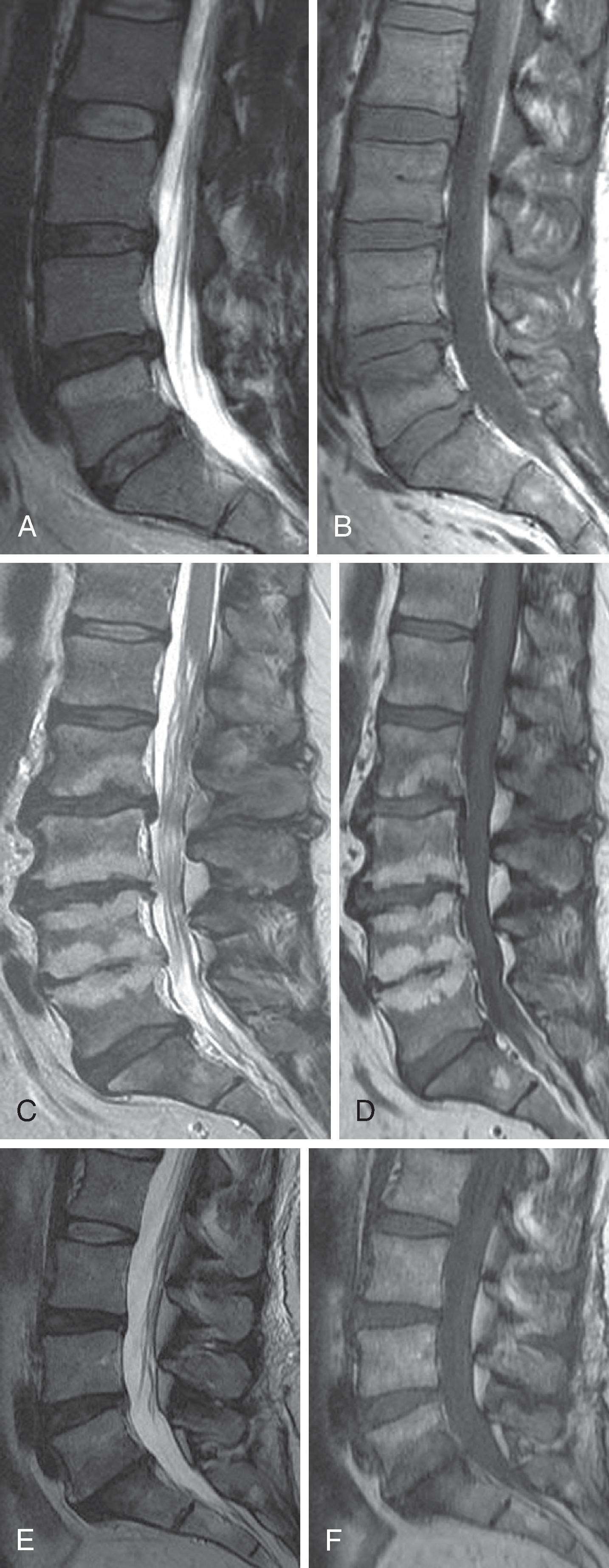 Figure 20.8, Modic endplate changes. Modic I sagittal T2 (A) and T1 (B) images demonstrate elevated T2 and diminished T1 signals involving the superior half of the L5 vertebral body. The histologic correlate of Modic I is vascularized granulation tissue. There are disc herniations at the L3–4 and L4–5 discs. Modic II sagittal T2 (C) and T1 (D) images reveal elevated T1 and T2 signals in the sub-endplate marrow involving L2–L5. The histologic correlate of Modic II is fatty infiltration. Modic III sagittal T2 (E) and T1 (F) images show diminished T2 and T1 signals in the sub-endplate marrow about the L5 interspace. The histologic correlate of Modic III is sclerotic bone.