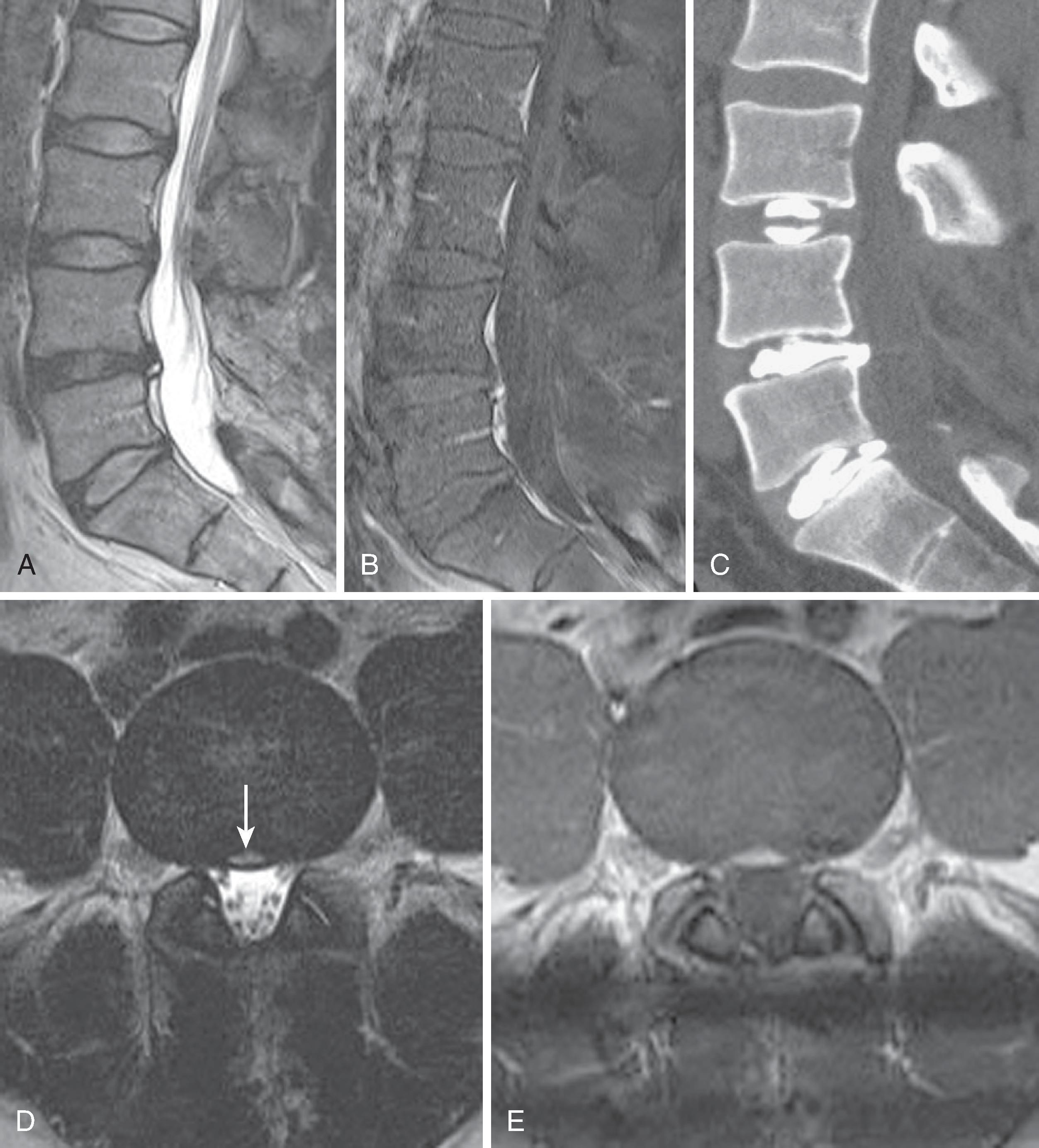 Figure 20.9, High intensity zone (HIZ). Middle-aged male has previously undergone L4–5 decompressive procedure, without discectomy, for back and leg pain. Axial back pain was unrelieved. A, Sagittal T2-weighted magnetic resonance image (MRI) shows loss of T2 signal in the L4 disc with an high intensity zone (HIZ) in the posterior annulus. D, Axial T2 MRI image at L4–5 interspace demonstrates the HIZ (arrow) in the posterior annulus. E, Axial-enhanced T1 MRI image showing enhancement in the HIZ, also demonstrated in the sagittal fat-saturated T1 image (B) . Sagittal postdiscogram computed tomography (C) demonstrates an annular fissure at L4–5 leading to HIZ. Pressurization of the L4–5 disc produced concordant axial pain at <20 pounds per square inch (PSI) above opening pressure. (From Maus TP, Aprill CN. Lumbar discogenic pain, provocation discography, and imaging correlates. Radiol Clin North Am. 2012;50:681–704.)