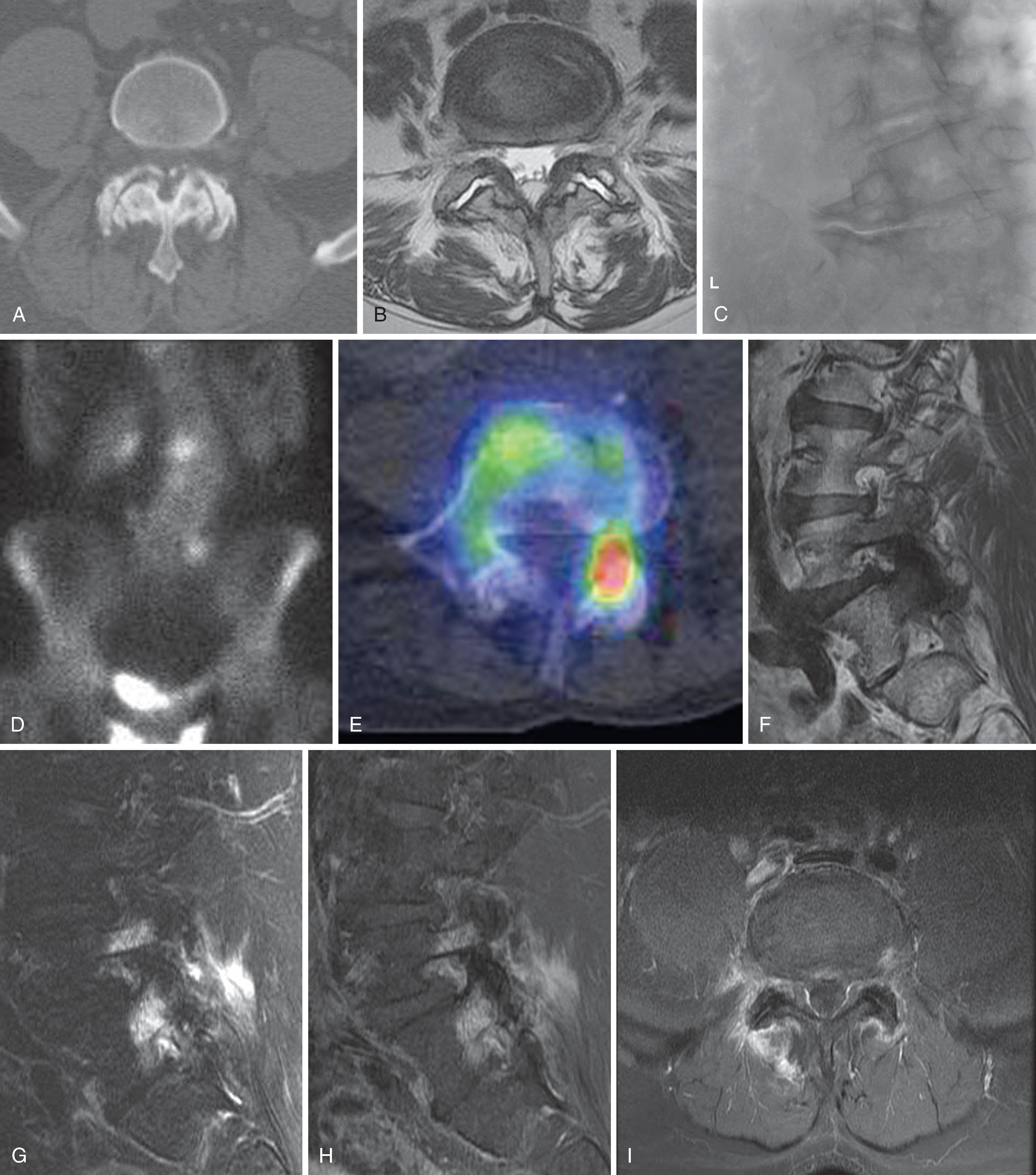 Figure 20.10, Imaging of facet arthrosis and synovitis. The changes of arthrosis (i.e. joint space narrowing, osteophytes, subchondral cysts, or sclerosis) as seen in the CT image (A) , the T2 MRI image (B) , or the radiographic image (C) do not correlate with pain. Planar bone scan image (D) of the same patient as (C) shows increased uptake near the lumbosacral junction on the left in this patient with left-sided axial pain. SPECT/CT image (E) provides better anatomic localization to the left L4–5 facet. In another patient with right-sided axial lumbar pain, T1 MRI image (F) shows a low signal in the right L5 pedicle and the right L4–5 facet. Fat-saturated T2 sagittal image (G) demonstrates T2 hyperintensity in L4 and L5 pedicles, L4–5 facet, and adjacent soft tissues. Enhanced T1 sagittal (H) and axial (I) images also demonstrate the extensive inflammatory response in this patient with active synovitis. T2 hyperintensity or enhancement in pedicles can occur in facet synovitis or stress fractures of the pars or pedicle. CT , Computed tomography; MRI , magnetic resonance image; SPECT , single-photon emission computed tomography.