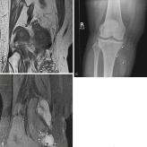 Fig. 3.11, Coronal T1-weighted ( A ) and coronal T2-weighted ( B ) images of right knee show prominent blood vessels intermixed with fat (arrows) typical of a venous malformation. Subtle hypointense signal on MRI (arrows) corresponds to calcified phleboliths easily visible on knee radiograph ( C ).