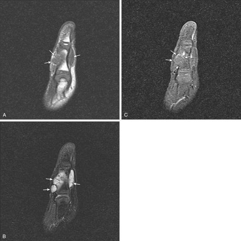 Fig. 3.12, Sagittal T1-weighted ( A ) and fat-suppressed T2-weighted ( B ) MR images of left thumb in 4-year-old boy show lobulated multiseptated mass wrapping around proximal phalanx. C, Postcontrast T1-weighted fat-saturated image shows minimal peripheral enhancement (arrows) and no central enhancement, typical of a lymphatic malformation.