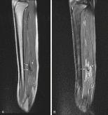 Fig. 3.14, Sagittal T1-weighted ( A ) and T2-weighted fat-suppressed ( B ) images show vascular malformation with flow voids, suggestive of an AVM.