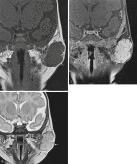 Fig. 3.15, Coronal T1-weighted ( A ) and coronal T2-weighted ( B ) MR images of 6-month-old boy show left-sided solid mass (arrows) . C, Diffuse contrast enhancement was observed on coronal T1-weighted fat-saturated image.