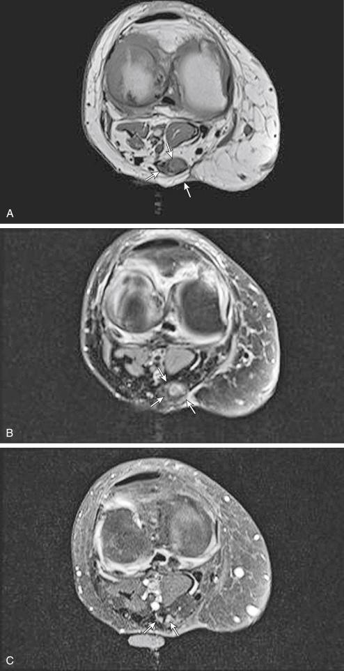 Fig. 3.17, Soft tissue mass in popliteal fossa with signal intensity similar to adjacent muscles on T1-weighted ( A ) and T2-weighted ( B ) images (arrows) . No significant enhancement was observed in postcontrast image ( C ).