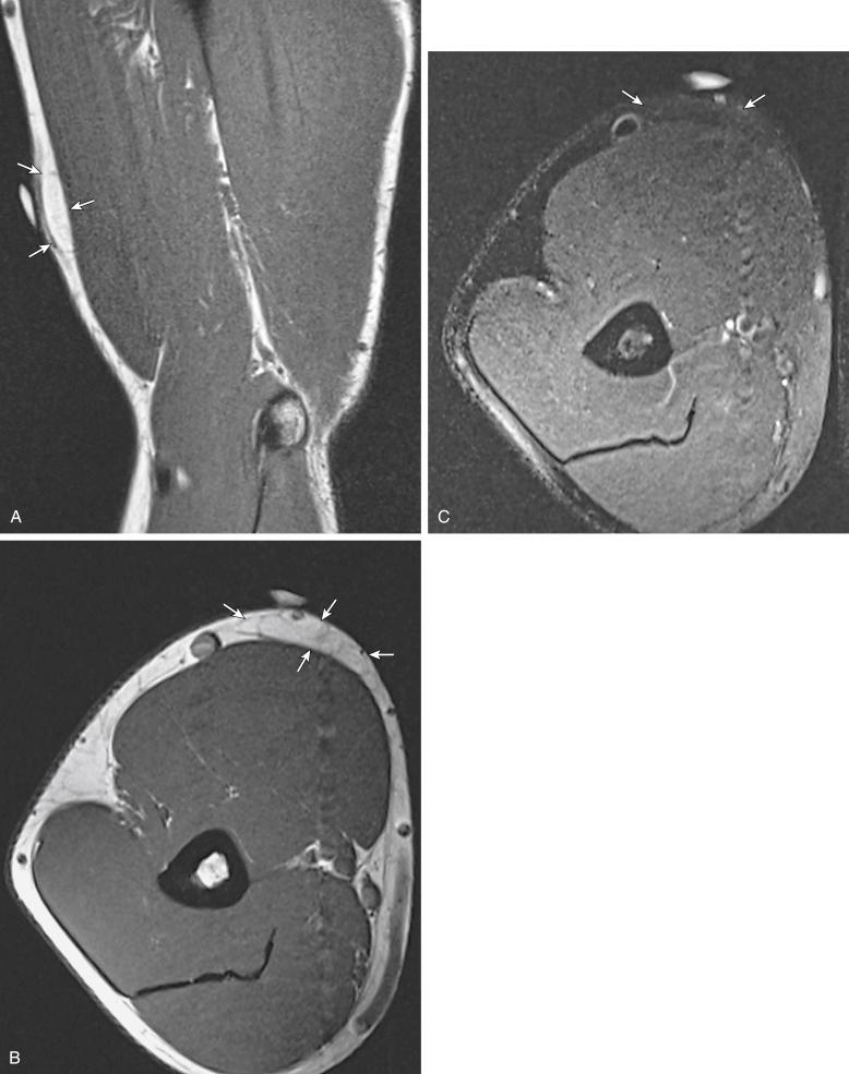 Fig. 3.3, Sagittal ( A ) and axial ( B ) T1-weighted images showing small subcutaneous mass with signal intensity identical to adjacent subcutaneous fat surrounded by thin capsule (arrows) consistent with a lipoma. C, Complete saturation of fat signal on fat-saturated T2-weighted axial image.