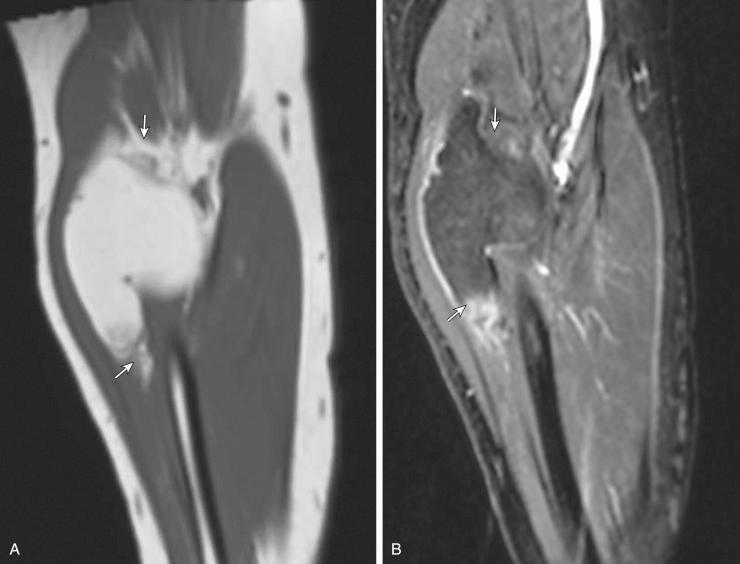 Fig. 3.4, A, T1-weighted coronal images of left forearm shows deep-seated lipoma with poorly defined margins (arrows) . B, Postcontrast T1-weighted fat-saturated images in coronal plane shows mild septal enhancement and poorly defined margins.