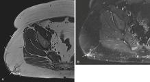 Fig. 3.5, A, Axial T1-weighted image of pelvis shows large fatty mass with ill-defined margins (arrows) . B, Linear area of nonfatty tissue (arrows) shows hyperintense signal on fat-suppressed T2-weighted axial images corresponding to fat necrosis on histologic examination.