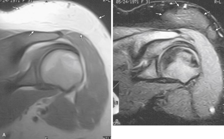 Fig. 3.6, A, Coronal T1-weighted image of left shoulder shows subcutaneous mass with signal intensity similar to that of adjacent subcutaneous tissues and poorly defined margins (arrows) . B, Fat-suppressed T2-weighted coronal image shows incomplete saturation of signal within this mass, not typical of simple lipoma. Excisional biopsy revealed a hibernoma.