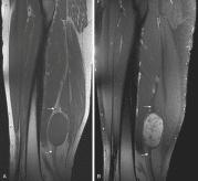 Fig. 3.7, Sagittal T1-weighted ( A ) and sagittal T2-weighted fat-suppressed ( B ) images of left thigh show intermuscular ovoid mass associated with sciatic nerve. Nerve fibers are visualized proximal and distal to the mass (arrows) .