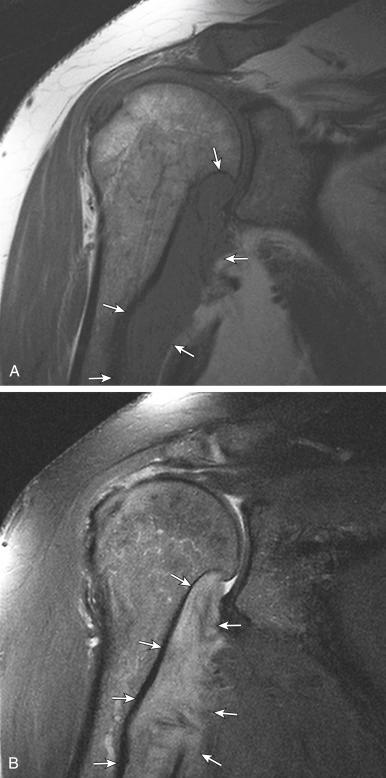 Fig. 3.8, A, T1-weighted coronal image of right shoulder shows tubular large lesion with poorly defined margins extending along proximal humerus medially (arrows) with smooth erosion of humeral cortex. B, Moderately diffuse enhancement of this mass (arrows) on postcontrast T1-weighted fat-saturated image.