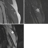 Fig. 3.9, Coronal T1-weighted ( A ) and T2-weighted ( B ) images of left arm show ovoid mass with proximal and distal curved linear areas of fat signal intensity (arrows) consistent with split fat sign, typical of a schwannoma. C, Postcontrast T1-weighted fat-suppressed image shows heterogeneous enhancement pattern (arrows) .