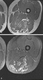 Fig. 3.10, Axial T1-weighted ( A ) and T2-weighted ( B ) images of left thigh show poorly defined masslike region composed of tubular structures consistent with blood vessels (arrows) . Note fatlike signal intermixed between these blood vessels.