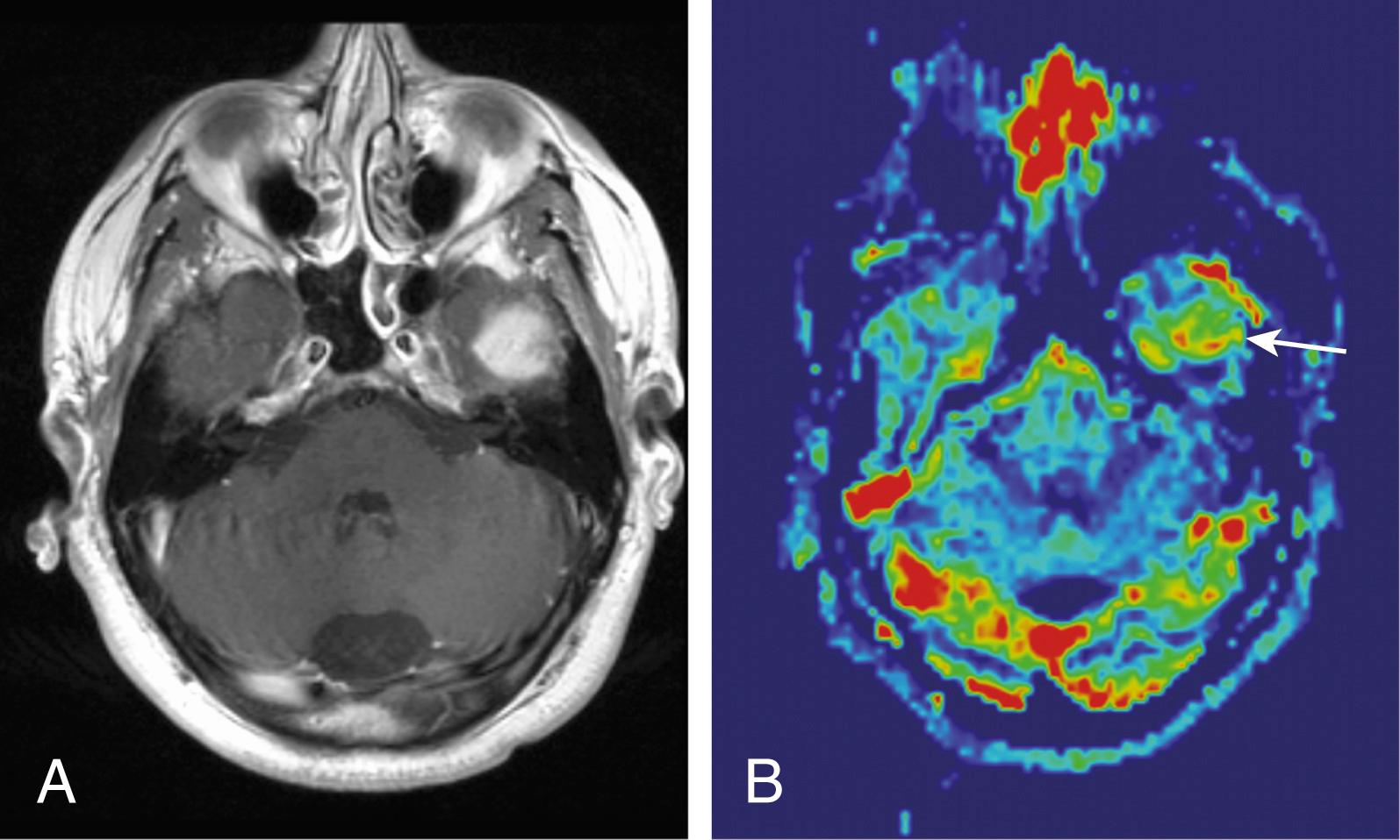 Figure 144.1, Meningioma on cerebral blood volume (CBV) imaging.