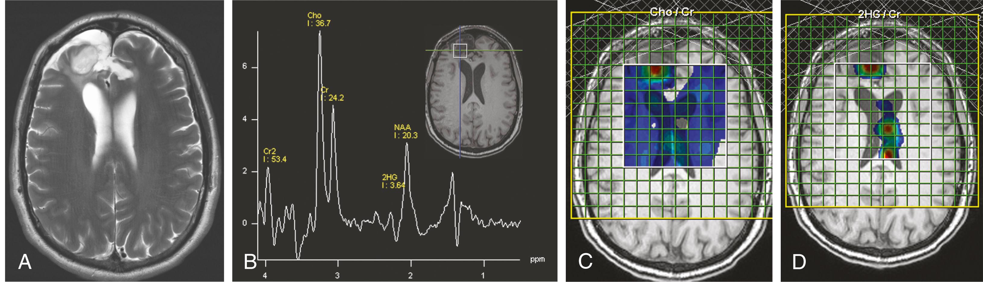 Figure 144.2, Magnetic resonance spectroscopy (MRS) of recurrent glioma.