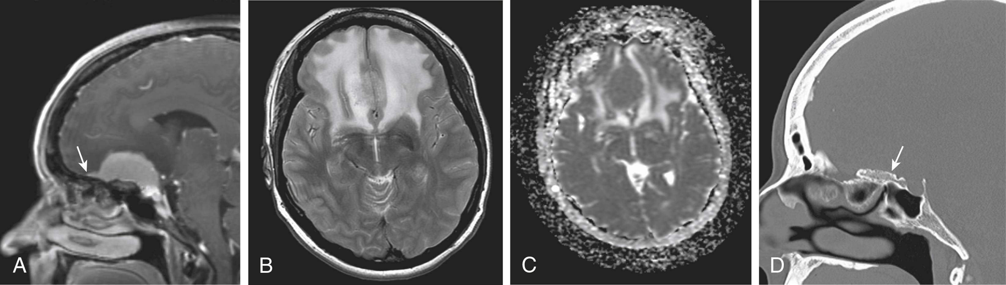 Figure 144.3, Planum sphenoidale meningioma.