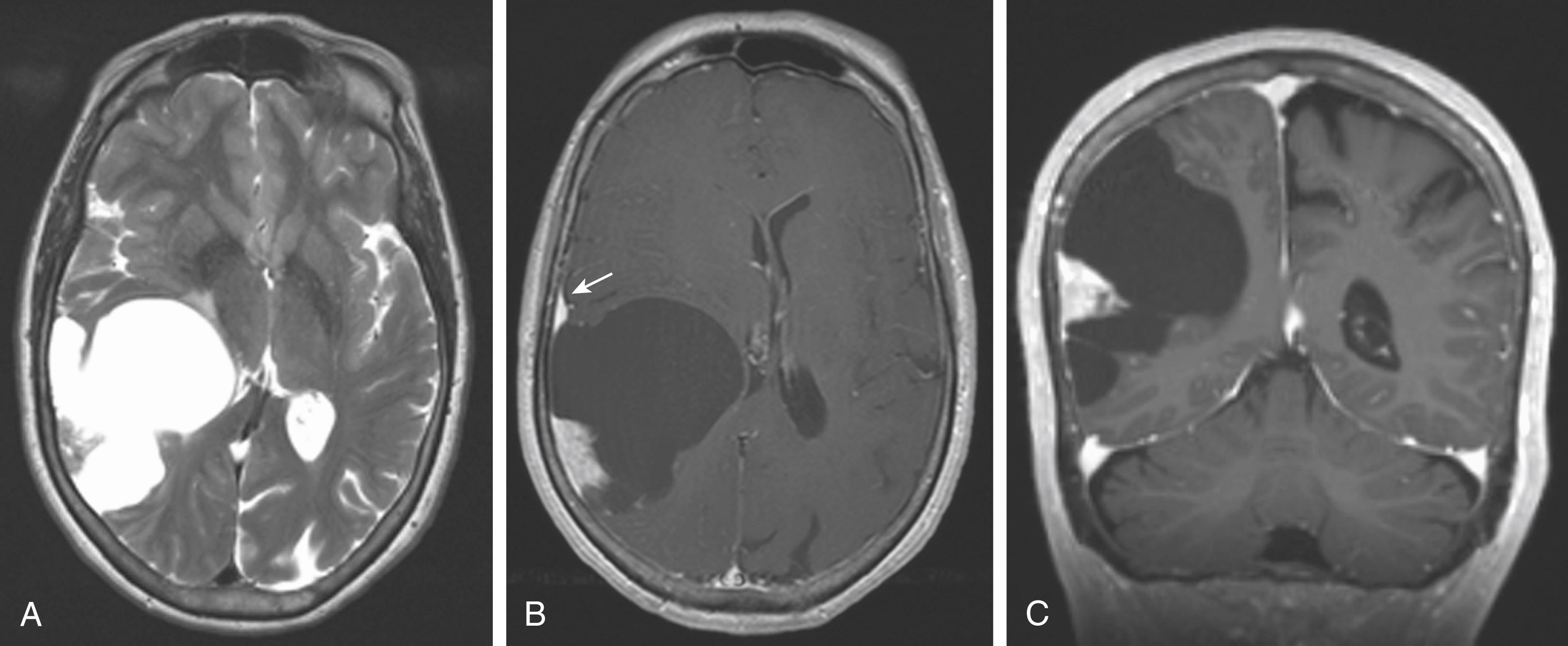 Figure 144.4, Cystic meningioma.