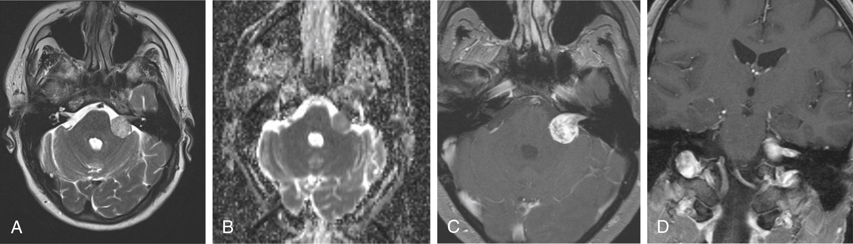 Figure 144.6, Vestibular schwannoma.