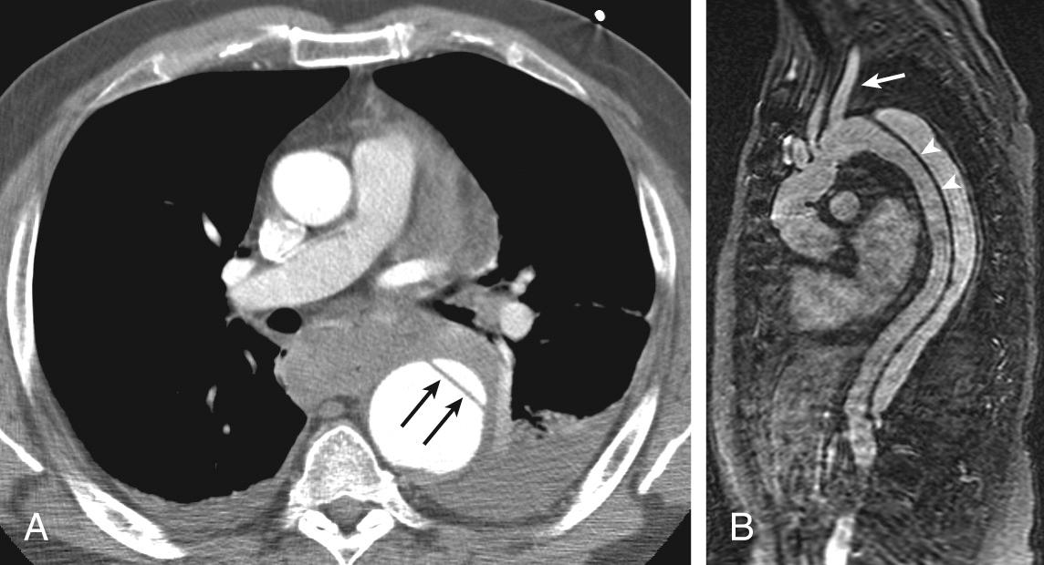 FIGURE 2-1, Type B aortic dissection. A, Axial contrast-enhanced chest computed tomography shows a dilated descending aorta and an intimal flap (arrows) . There are small pleural effusions and increased attenuation of mediastinal adipose tissue raising the possibility of hemorrhage within the mediastinum. B, Sagittal oblique magnetic resonance imaging of the aorta shows an intimal flap (arrowheads) arising distal to the left subclavian artery (arrow) .