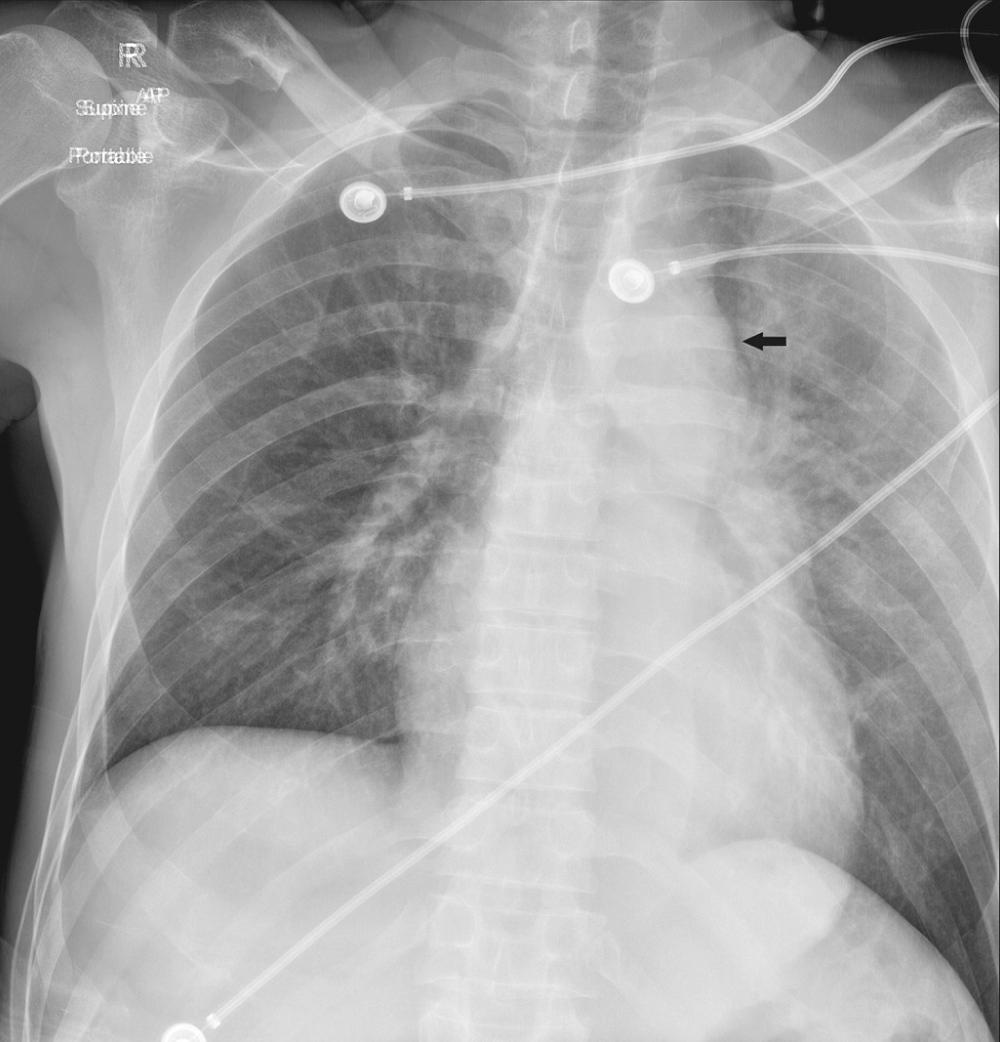 FIGURE 2-2, Traumatic aortic injury. Portable chest radiograph shows widening of the superior mediastinum, lobular contour abnormality of the transverse aorta (arrow) , indistinct descending aorta, and opacities in the left lung consistent with pulmonary contusion/hemorrhage.