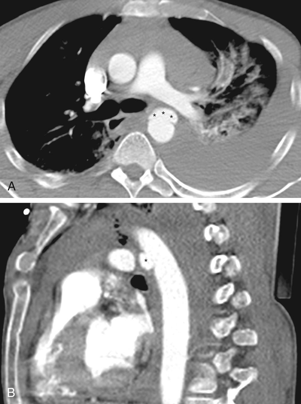 FIGURE 2-3, Traumatic aortic injury after motor vehicle accident. A, Axial contrast-enhanced chest computed tomography (CT) shows focal contained collection of contrast (asterisks) located external to the descending aorta, consistent with a pseudoaneurysm. Note mediastinal widening due to hemorrhage and moderate pleural effusion. B, Sagittal reconstructed CT shows pseudoaneurysm arising from the thoracic aorta immediately distal to the transverse arch (asterisk) .