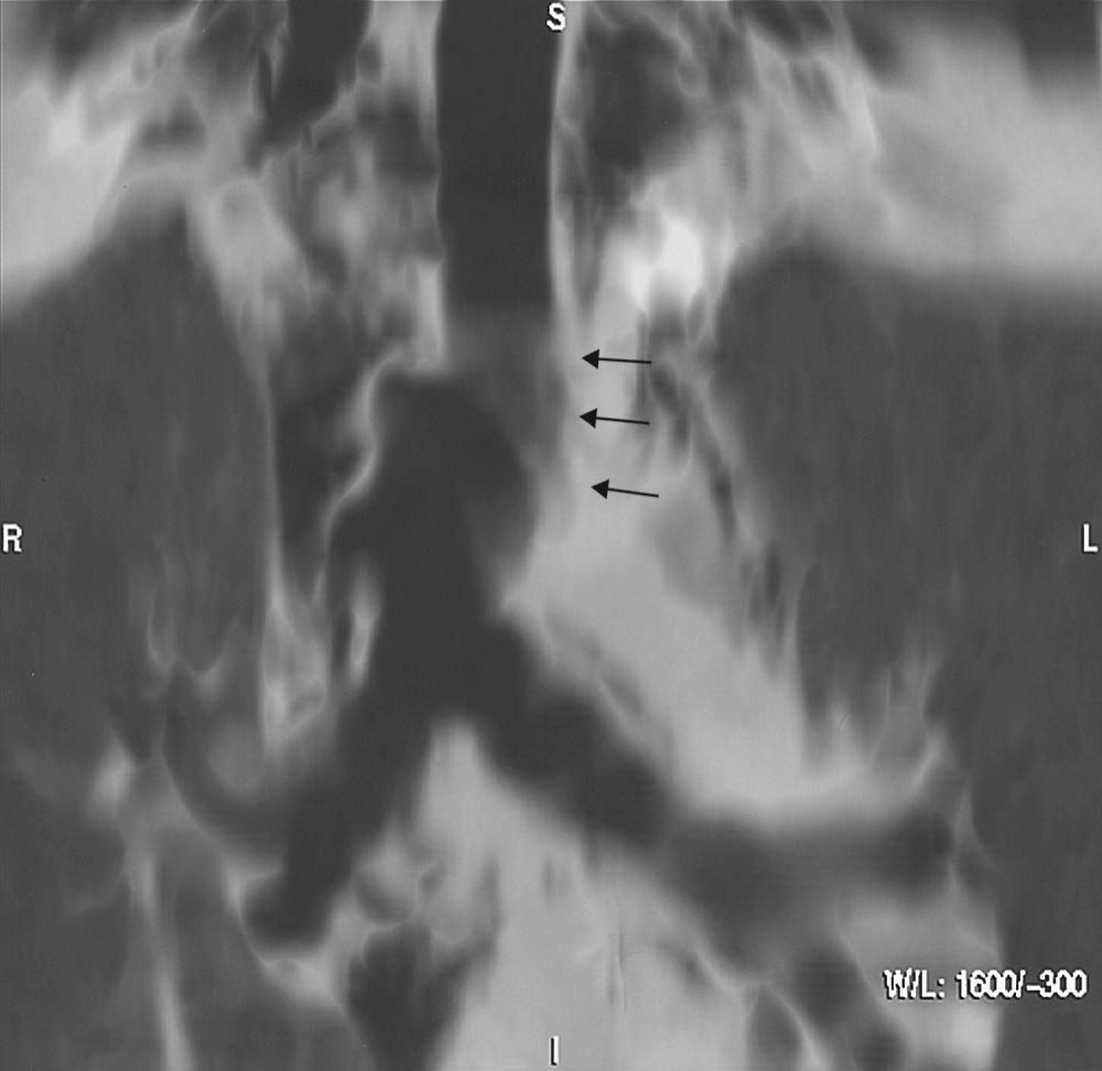 FIGURE 2-4, Tracheal rupture after a motor vehicle crash in a patient with no respiratory symptoms and a chest radiograph demonstrating pneumomediastinum. Coronal reformations of computed tomography (2.5-mm collimation) show pneumomediastinum and discontinuation of the trachea (arrows) .