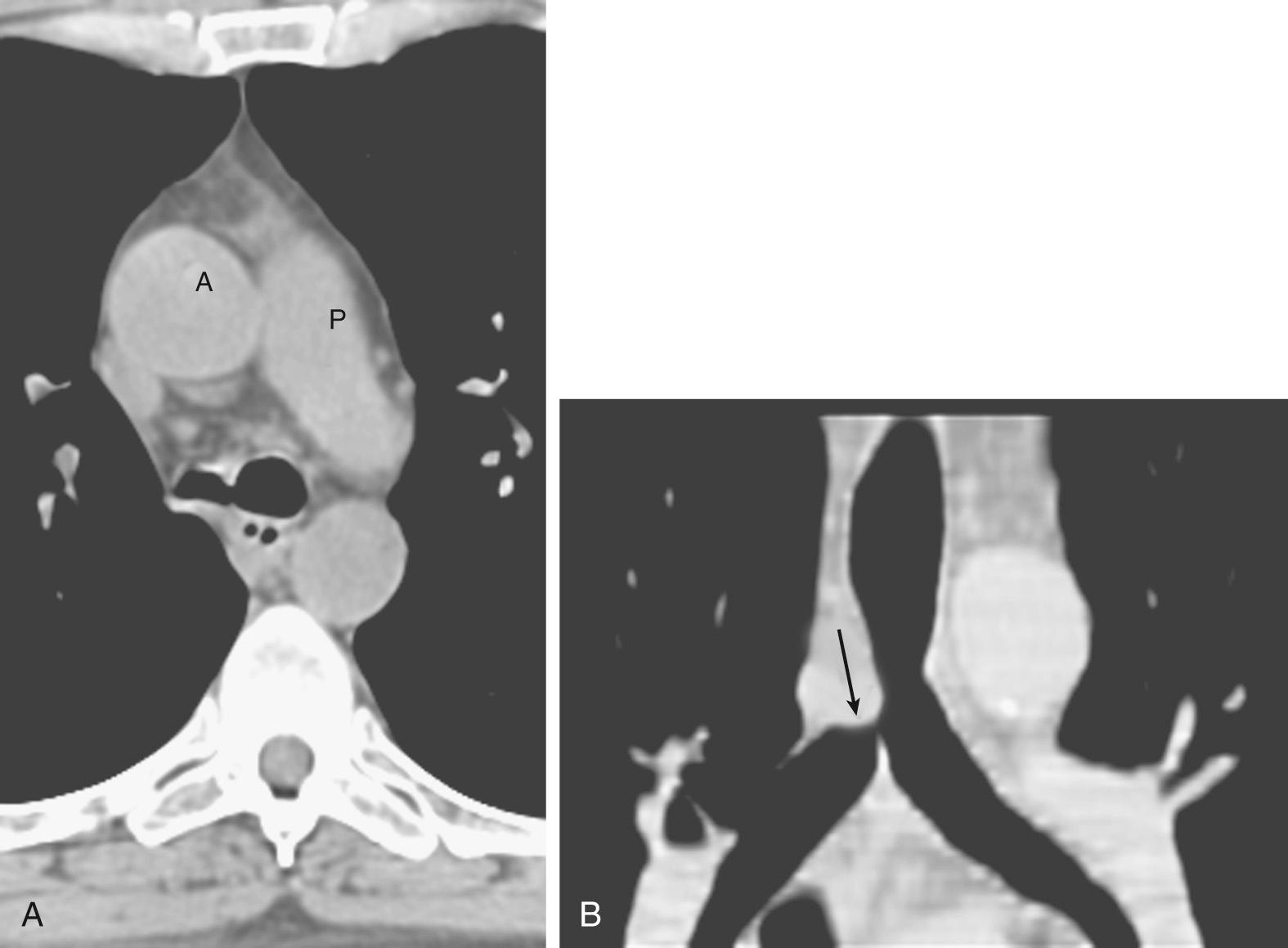 FIGURE 2-5, Focal stenosis of the right main-stem bronchus from invasive aspergillosis. A, Axial computed tomography shows normal caliber of left main bronchus and marked concentric narrowing of right main bronchus. B, Coronal reconstruction shows that the right main bronchus stenosis involves a short focal segment (arrow) . A, Ascending aorta; P, pulmonary artery.