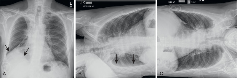 FIGURE 1.3, Decubitus views. Standard upright radiograph (A) demonstrates right subpulmonic pleural effusion (arrows) . In the right lateral decubitus position (B) , the pleural fluid is layering along the dependent right lateral chest wall (arrows) . In the left lateral decubitus position (C) , the fluid has moved away from chest wall, indicating freely flowing fluid. Note radiation therapy changes in the right perihilar lung related to treated lung cancer.