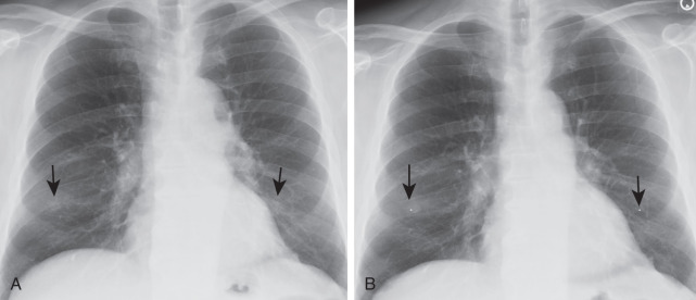 FIGURE 1.4, Nipple markers. A standard radiograph (A) demonstrates bilateral nodular opacities in the lower chest (arrows) . A radiograph with nipple markers (B) demonstrates that the nodules correspond to nipples.