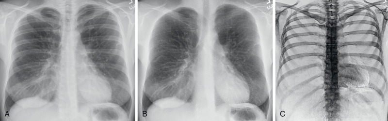 FIGURE 1.6, Subtraction using dual-energy double-exposure technique. Multiple bilateral pulmonary nodules and masses on the standard chest radiograph (A) are better seen on the bone-subtracted image (B) . Note the increased conspicuity of the ribs on the bone-subtraction image (C) . The bone-only image removes the lung findings and is helpful for the detection of bone findings.