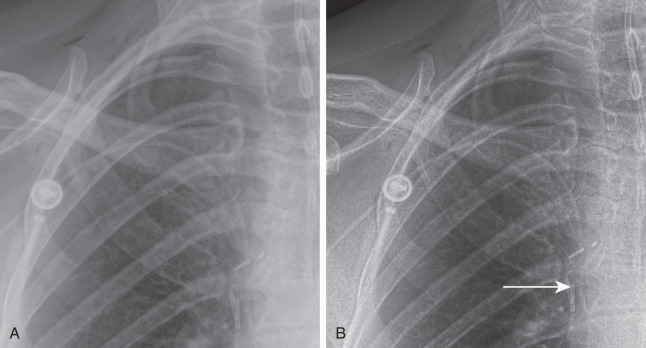 FIGURE 1.7, Edge enhancement technique. The tip of the right peripherally inserted central catheter (PICC) line is difficult to see on standard chest radiograph (A) . With edge enhancement technique (B) , the PICC line and its tip are better visualized (arrow) .