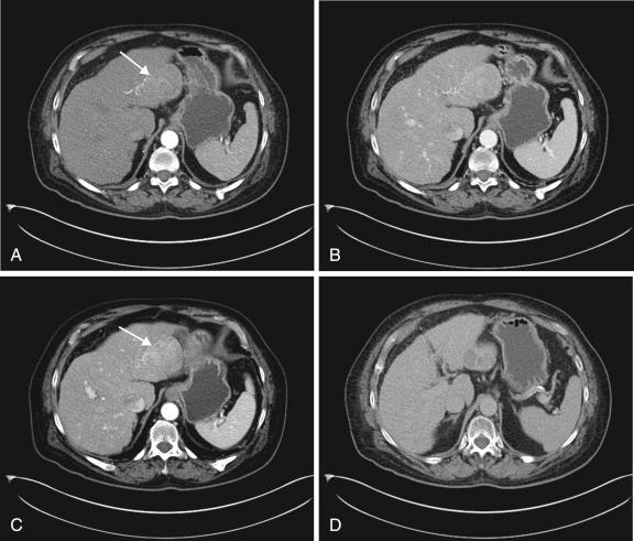 FIGURE 35-1, Triple-phase computed tomography of patient with hepatocellular carcinoma (HCC) and cirrhosis.
