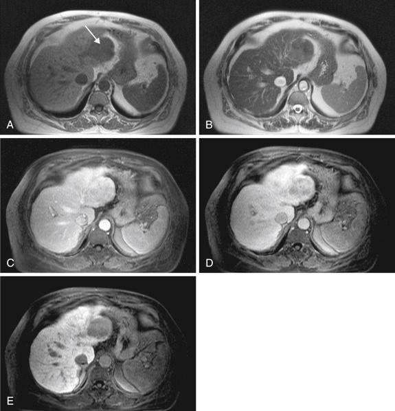 FIGURE 35-2, Magnetic resonance imaging of same patient as in Figure 35-1 with hepatocellular carcinoma (HCC) and cirrhosis performed a few weeks later using the extracellular-hepatobiliary agent gadoxetic acid. A, Precontrast T1-weighted in-phase images show the left lobe lesion to be hypointense relative to the rest of the liver (arrow) . B, Precontrast T-2 half-Fourier acquisition single-shot turbo spin-echo (HASTE) image shows the left lobe lesion to be hypointense similar to the rest of the liver. C, In the early arterial phase of the contrast injection the left lobe lesion is seen to be hyperintense. D, Three minutes following injection the HCC is showing patchy washout with decreased signal. In the dynamic phases (arterial, portovenous, and equilibrium phases) the extracellular-hepatobiliary agents behave similarly to conventional extracellular gadolinium-containing contrast agents with rapid arterial enhancement followed by washout. E, Twenty minutes following gadoxetic acid injection the HCC is seen to be hypointense relative to the rest of the liver because of its inability to take up the gadoxetic acid. The rest of the liver is bright because the hepatocytes have taken up the gadoxetic acid.