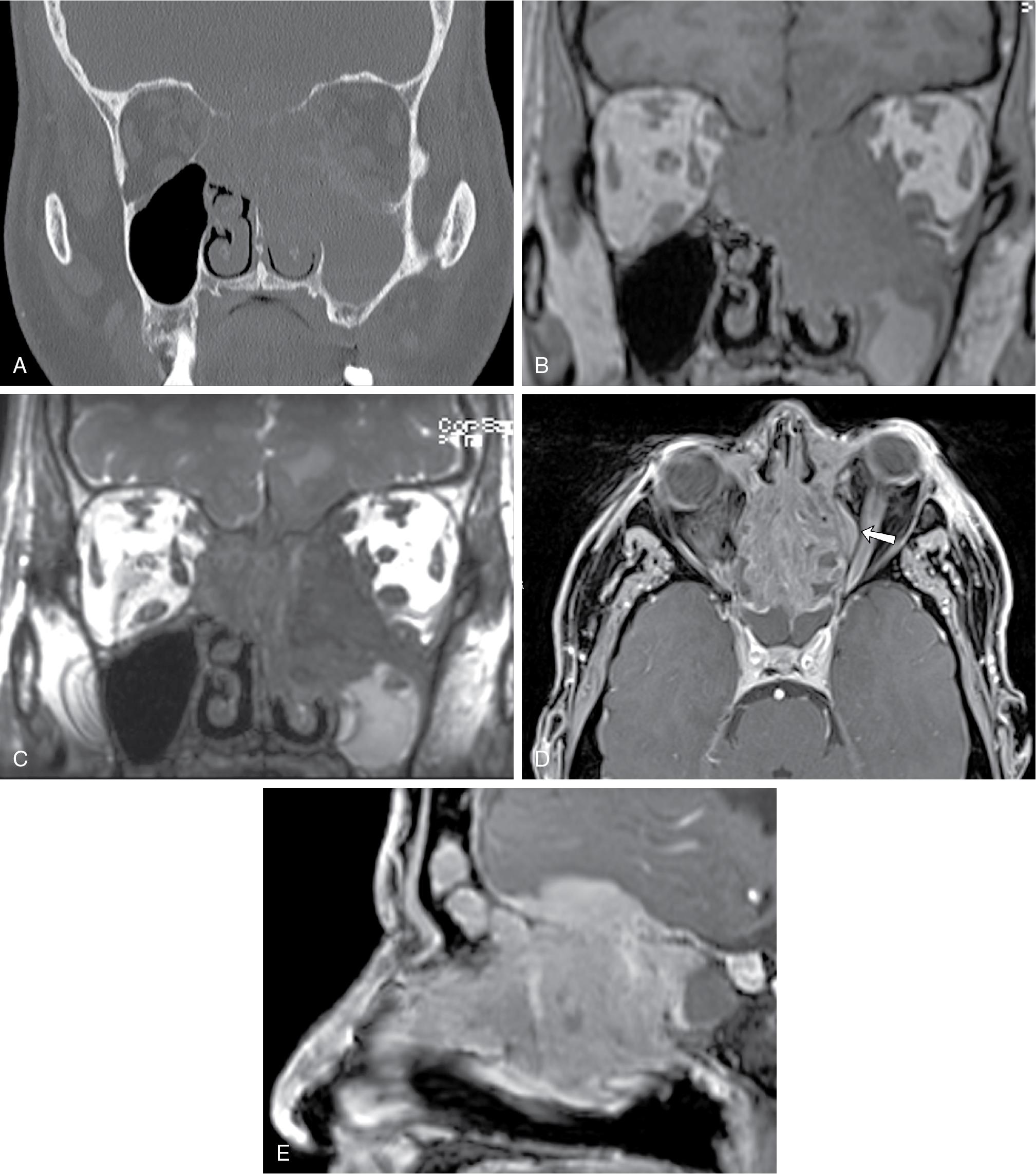 Fig. 27.1, Sinonasal carcinoma with skull base and orbital invasion. This 52-year-old man presented with left orbital pain, swelling, and proptosis. ( A ) Coronal noncontrast maxillofacial computed tomography (CT) in bone windows demonstrates opacification of the left maxillary sinus, ethmoid air cells, and nasal cavity with destruction of the cribriform plate, turbinates, bilateral medial and left inferior orbital walls, and nasal septum. On CT, it is not entirely clear how much opacification is attributable tumor versus trapped secretions. On magnetic resonance imaging (MRI), coronal T1 precontrast ( B ) and constructive interference in steady state ( C ) images demonstrate different signal intensity between the darker signal mass and brighter signal trapped proteinaceous secretions. Soft tissue contrast between the mass and adjacent fat demonstrated the tumoral invasion into the bilateral medial extraconal orbits. Deficiency of the anterior skull base is also appreciable on MRI, but there is also high signal in the left inferior frontal lobe, indicating intracranial tumor involvement. Postcontrast MRI images demonstrate invasion of the mass into the bilateral medial orbits via the lamina papyracea (the arrow indicates left-sided involvement) ( C ) as well as bulky dural-based tumor burden along the anterior cranial fossa floor ( D ). Biopsy of this mass demonstrated poorly differentiated carcinoma.