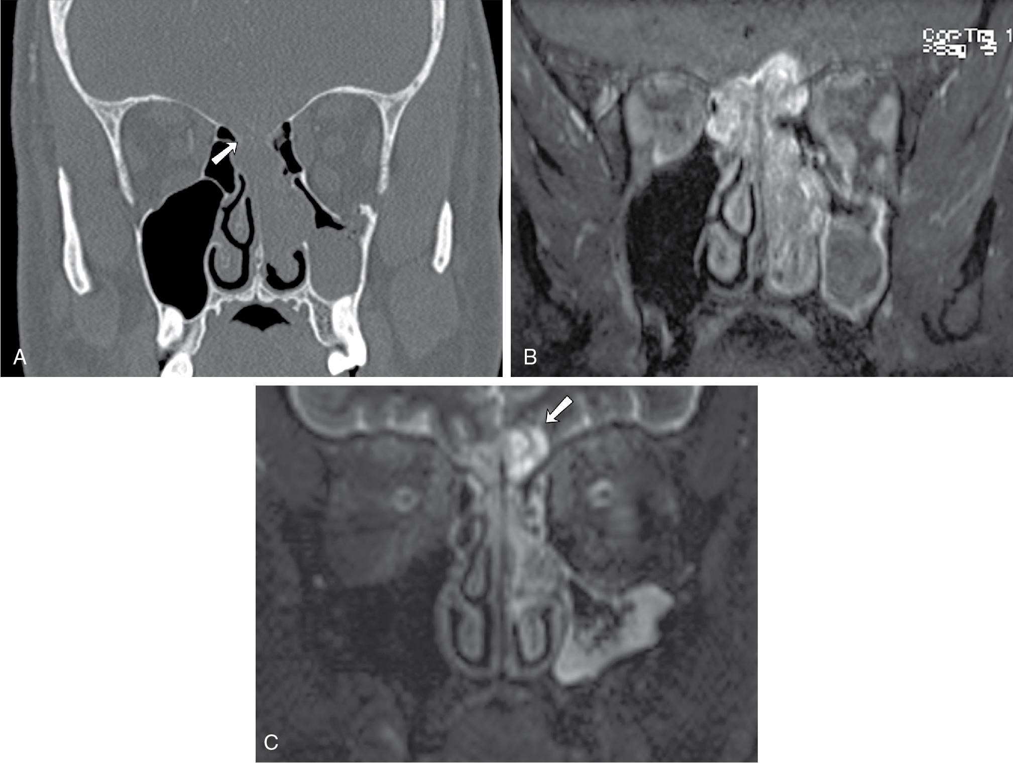Fig. 27.2, Olfactory neuroblastoma. This 49-year-old man presented with left rhinorrhea and nasal obstruction. A, Coronal noncontrast computed tomography demonstrates opacification of the left nasal cavity with dehiscence at the anterior skull base (arrow) , with expansile soft tissue within the nasal cavity. B, Contrast-enhanced magnetic resonance imaging demonstrates the enhancing sinonasal mass with bulky tumor in left nasal cavity and additional tumor burden in the right superior nasal cavity that extends into the anterior skull base. C, Coronal T2-weighted image shows marginal tumor cysts (arrow) typical of olfactory neuroblastoma.