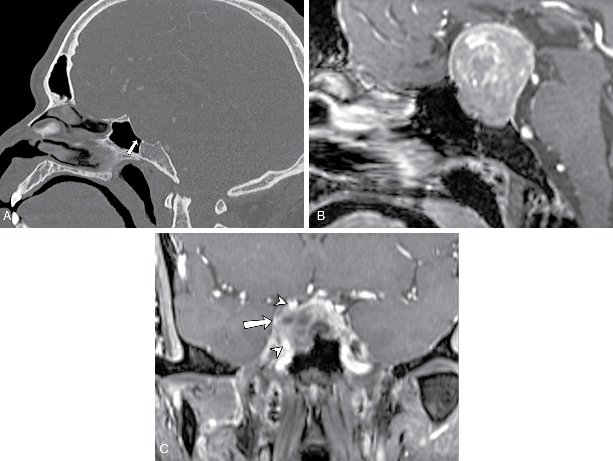 Fig. 27.3, Pituitary macroadenomas. A, Sagittal computed tomography image of a patient with a pituitary macroadenoma demonstrates smooth remodeling of the floor of the sella (arrow) . B, Corresponding postcontrast T1-weighted magnetic resonance imaging demonstrates an enhancing lobulated sellar mass with suprasellar extension, in position to compress the optic chiasm. C, Postcontrast T1-weighted image on a different patient with a pituitary macroadenoma demonstrates tumor invasion (arrow) beyond the lateral margin of the right internal carotid artery (arrowheads) indicating that cavernous sinus invasion is very likely.