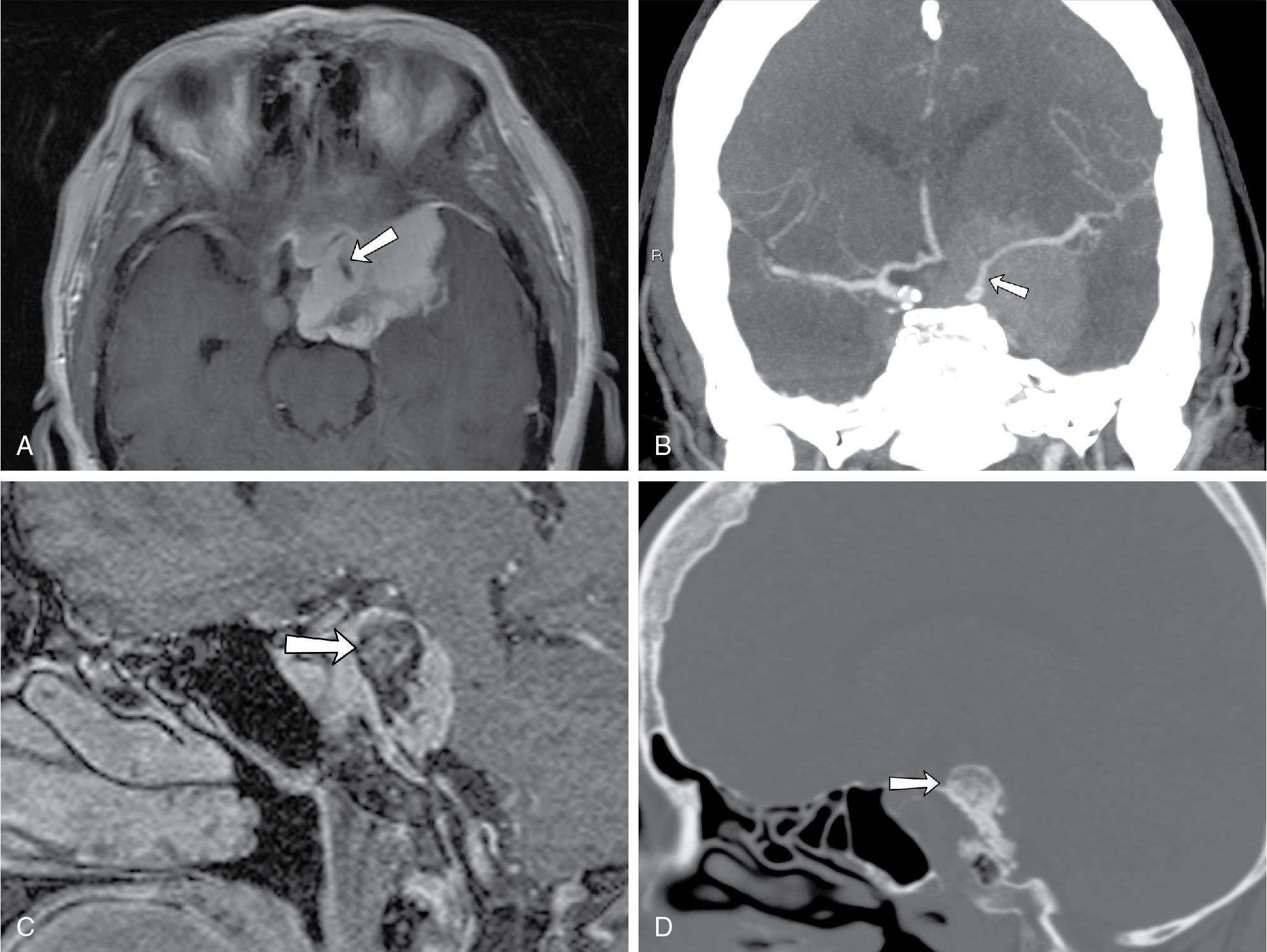 Fig. 27.4, Skull base meningioma. A, This 69-year-old woman had a large central skull base meningioma, evidenced by homogeneously enhancing extraaxial dural-based mass centered in the left paracavernous region. The mass extends into the sella, left middle cranial fossa, and prepontine cistern and encases and narrows the left cavernous carotid artery flow void (arrow) . B, Internal carotid artery narrowing (arrow) is confirmed on computed tomography angiography evaluation. Note early avid arterial enhancement of the mass, typical of meningiomas. C, Sagittal postcontrast T1-weighted image of a 64-year-old woman with a bulky retroclival meningioma compressing the ventral brainstem with associated clival hyperostosis (arrow) , best appreciated on sagittal computed tomography ( D , arrow ).