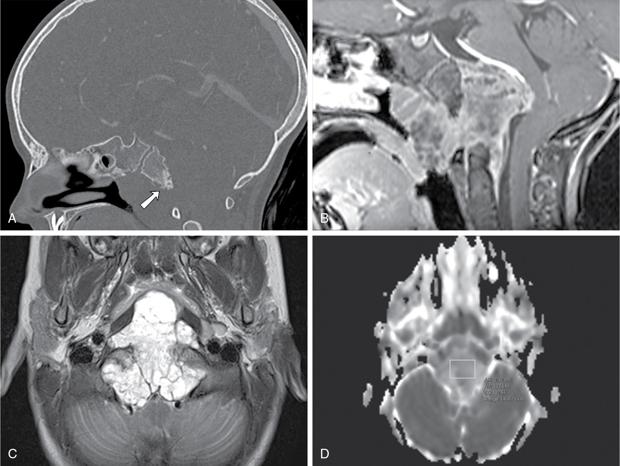 Fig. 27.5, Clival chordoma. This 5-year-old girl presented with increased snoring and apneic episodes was referred for adenoidectomy. A, Sagittal computed tomography demonstrates osseous lytic destruction of the inferior clivus (arrow) . B, Contrast-enhanced T1-weighted magnetic resonance imaging demonstrates a heterogeneously enhancing mass in this location, with bulky prevertebral and retroclival soft tissue components resulting in narrowing of the nasopharyngeal airway and mass effect on the ventral brainstem. C, Axial T2-weighted image demonstrates a midline location and prominent bright signal. Note septations within the lesion and displacement of vertebral artery flow voids bilaterally at the posterior tumor margin. D, The apparent diffusion coefficient value of the mass measured 1266, typical for a chordoma.