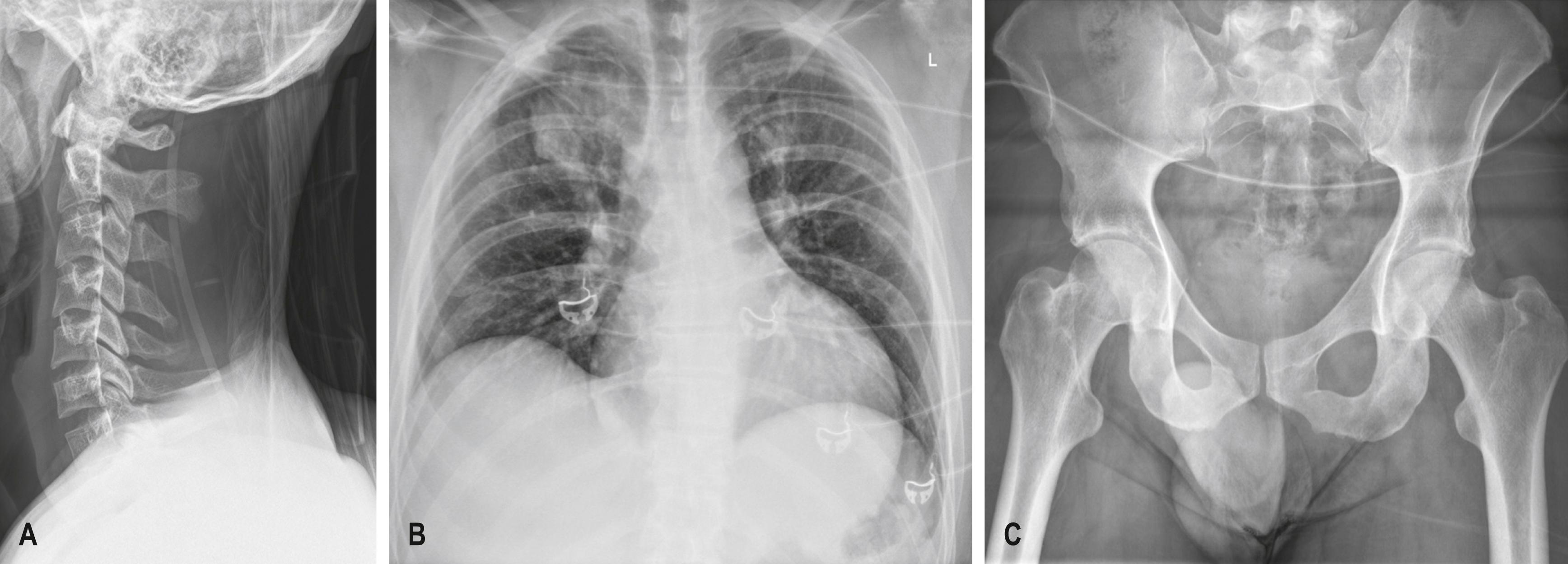 FIG. 3.8.1, (A) Normal lateral cervical radiograph from a trauma series. (B) Chest x-ray from a trauma series with right-upper-zone pulmonary contusion. (C) Normal pelvic x-ray from a trauma series.